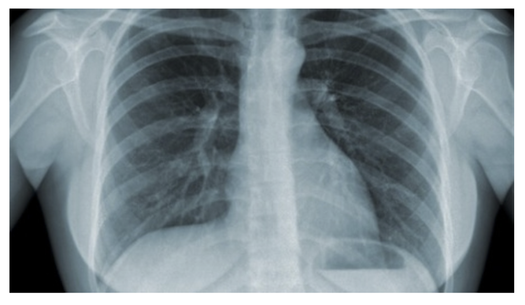 Preview image for Tuberculosis (online course)
