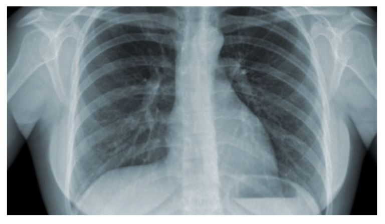 Preview image for Tuberculosis (online course)